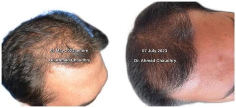 Stem Cell Hair Loss Treatment Clinic Lahore Pakistan Call Us Now