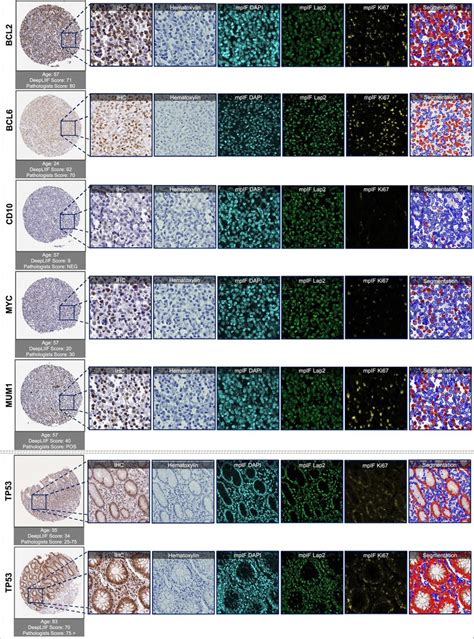 Deepliif Results On Dlbcl Ihc Markers Examples Of Tissues Stained With