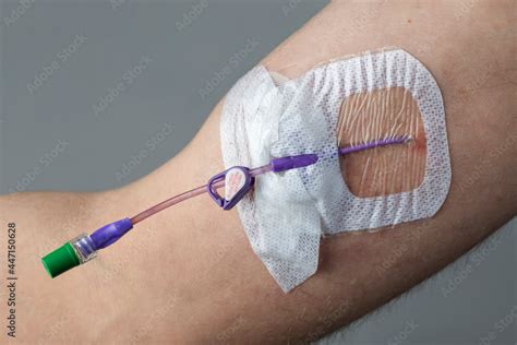 Picc Peripherally Inserted Central Catheter In The Arm Of A Man Stock