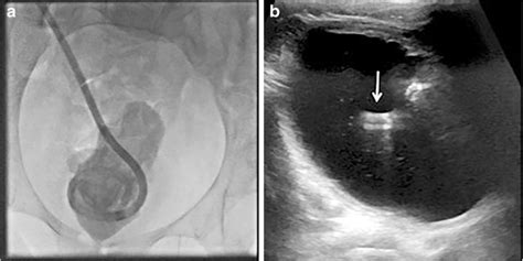 A Pigtail Catheter Can Be Used To Drain The Renal Pelvis Or As A