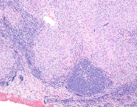 Photomicrograph Of The Lymph Node Biopsy Specimen Shows Nonnecrotizing Download Scientific