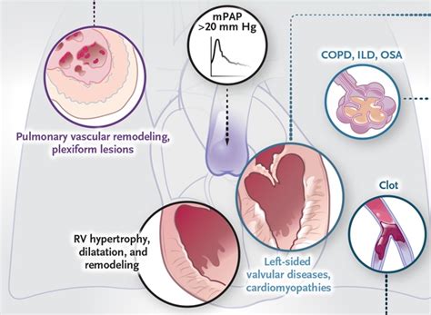 Pulmonary Arterial Hypertension Nejm Resident 360