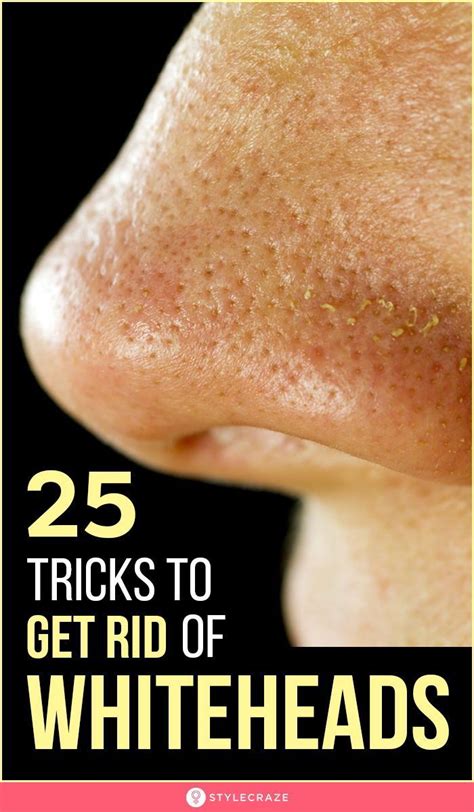 25 Best Remedies To Get Rid Of Whiteheads On Face And Nose In 2020