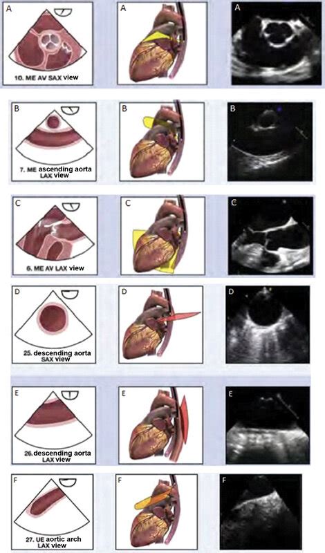 Transesophageal Echocardiogram