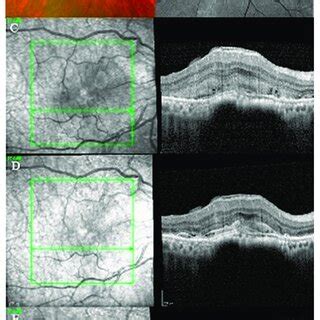 Case Multimodal Imaging Features Of Bacillary Layer Detachment