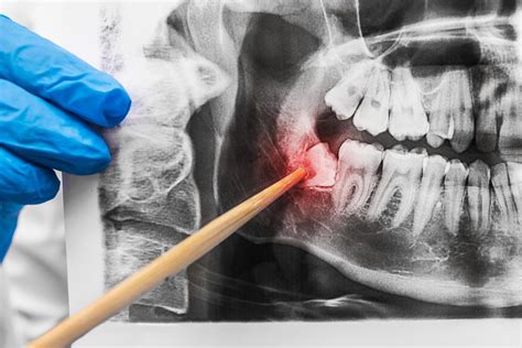 Impacted Wisdom Teeth: Symptoms, Diagnosis & Treatment