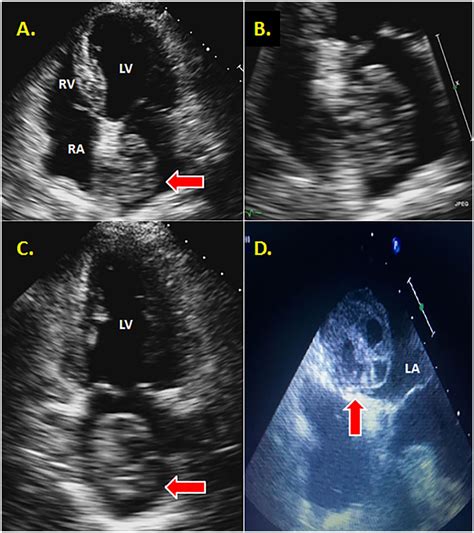 Differentiation Of Left Atrial Myxomas By Multimodality Imaging Eric