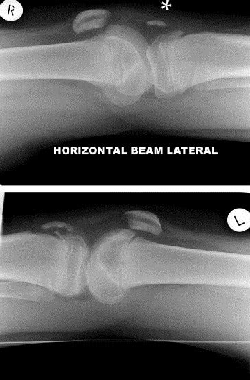 Simultaneous Bilateral Avulsion Fractures Of The Tibial Tuberosity In