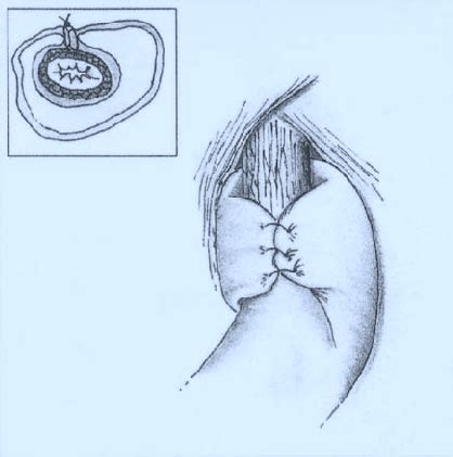 Technique of the Toupet (270°, posterior) fundoplication | Download Scientific Diagram