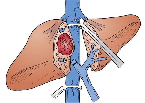 Vascular Reconstruction Techniques In Hepato Pancreato Biliary Hpb