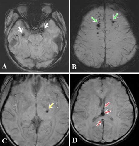 Diffuse Axonal Injury A Case Report And MRI Findings PMC