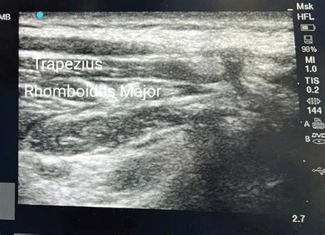 The Trapezius Plane Block Extended Use In Perioperative Pain