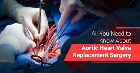 All You Need To Know About Aortic Heart Valve Replacement Surgery By Heart Affairs Medium