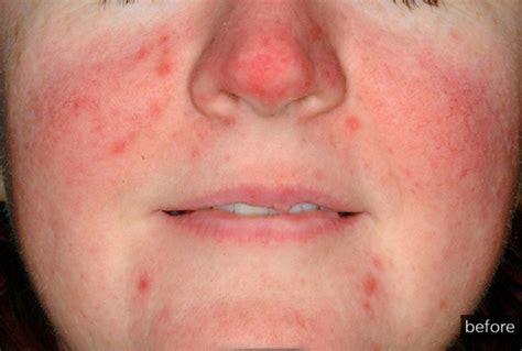 The Day Of Treatment Rosacea And Dry Eye Problems