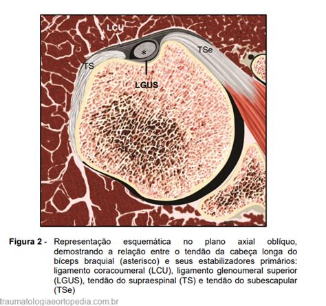 Instabilidade Do Tendão Da Cabeça Longa Do Bíceps Traumatologia E