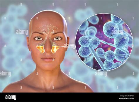 Candida Yeast Fungi As A Cause Of Sinusitis Computer Illustration