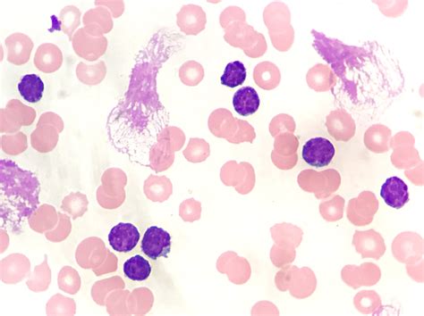 LEUCEMIA LINFOCÍTICA CRÓNICA EduLabC