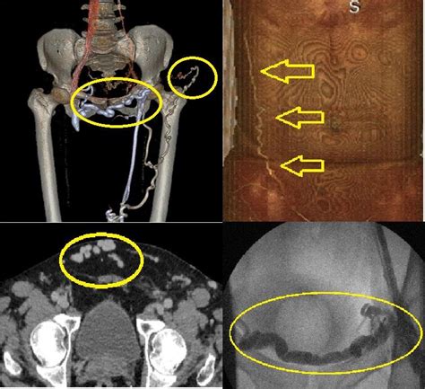 -venous collaterals in venography | Download Scientific Diagram