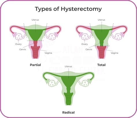 Understanding Total Hysterectomy A Patients Perspective