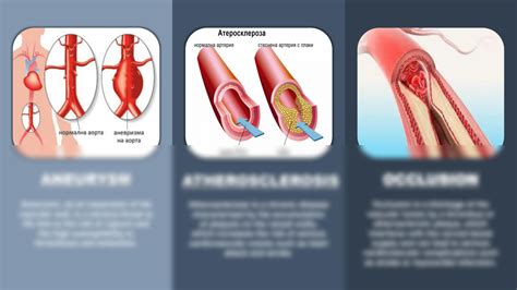 Solution Treatments On Aortic And Peripheral Vascular Diseases Methods Innovations And Outcomes