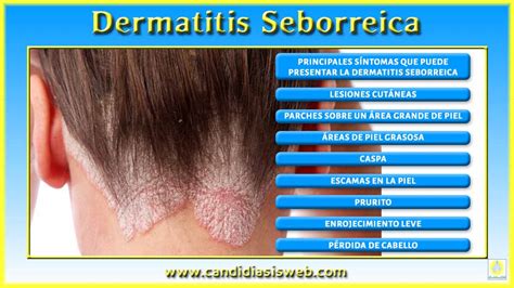 Enfermedades Por Hongos Dermatitis Seborreica