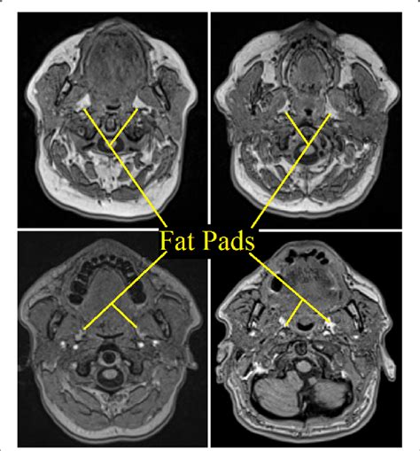 Diverse Appearance Of Para Pharyngeal Fat Pads On Axial Slices Download Scientific Diagram