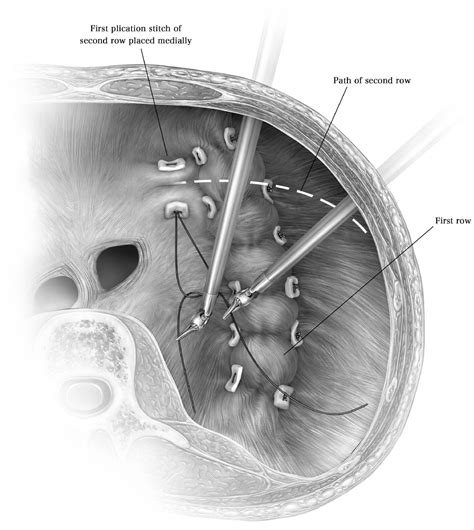 Robot-Assisted… | The American Association for Thoracic Surgery | AATS