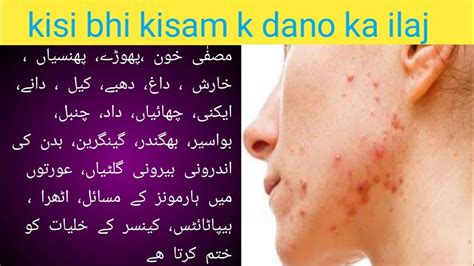 Face K Dano Ka Ilaj Face K Dane Khatam Karne Ka Tarika Acne Khatam