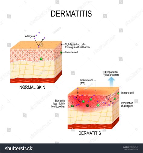 Skin Infection Over 25 513 Royalty Free Licensable Stock Illustrations