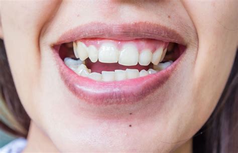 Trismus dental todo lo que tienes que saber Clínica Cidad Nuestro