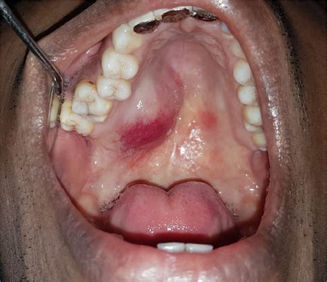 An Extensive Nodular Lesion Involving Hard Palate And Nasal Turbinate