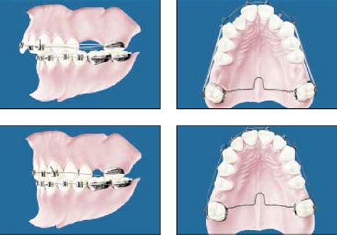 A Treatment Method For Class II Division 1 Patients With Extraction Of