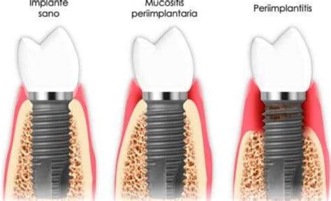 O que são doenças peri implantares Descubra aqui
