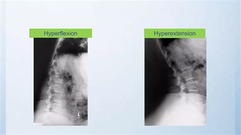 Radiographic Views Of Lumbar Spine Ppt