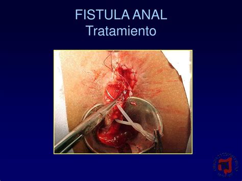 PPT CONCEPTOS ACTUALES EN EL TRATAMIENTO DE LA FISTULA ANAL