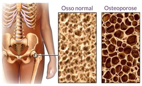 Densitometria óssea Um exame de grande importância para prolongar a vida