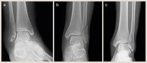 Ankle Fractures And Their Management Surgery Oxford International