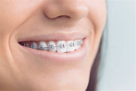 Whats The Difference Between Braces And Invisalign