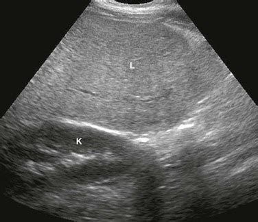 Parenchymal Liver Disease Radiology Key