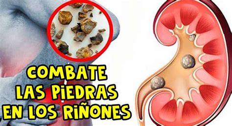 Cómo sacar las piedras del riñón con cuatro ingredientes Remedios