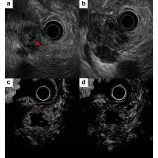 Endoscopic Ultrasonography Revealed Hypoechoic And Homogenous