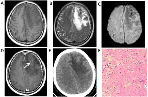 Neuroimaging Findings Of Cerebral Syphilitic Gumma