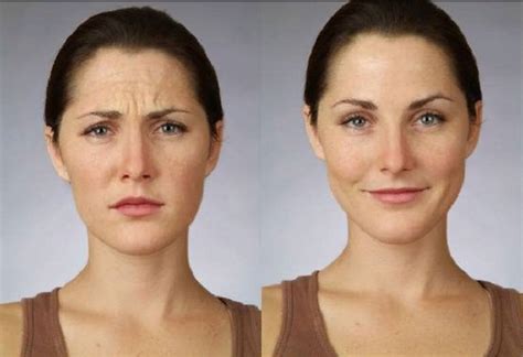 Уколы ботокса в лоб | Botox, Botox injections, Natural face lift