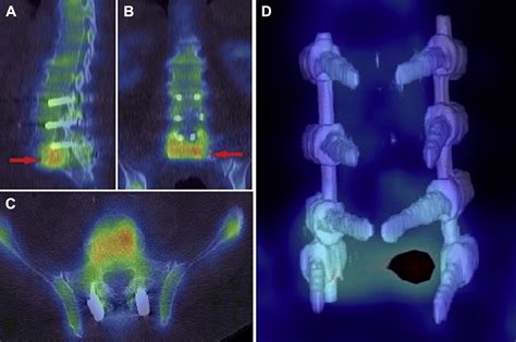 Hybrid Imaging Spect Computed Tomography With Three Dimensional