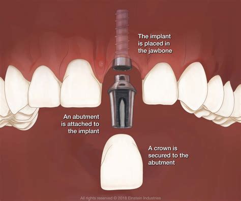 Dental Implants Washington DC Implant Dentistry RUSK THORNTON