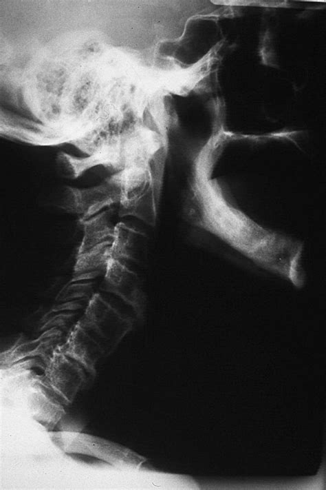 Long Term Results Of Surgical Treatment Of Dysphagia Secondary To Cervical Diffuse Idiopathic