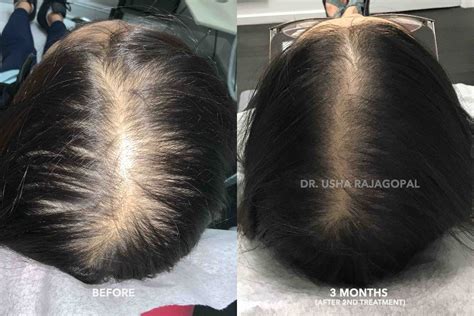 Hair Regrowth Therapy With Acell Prp San Francisco Bay Area Usha Rajagopal Md