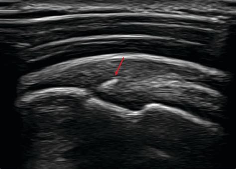 The Evolving Roles Of Mri And Ultrasound In First Line Imaging Of Rotator Cuff Injuries Ajr