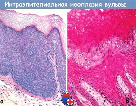 Рак (карцинома) наружных половых органов женщин