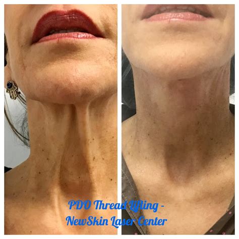 Before After Photo Northridge Simi Valley New Skin Laser Center